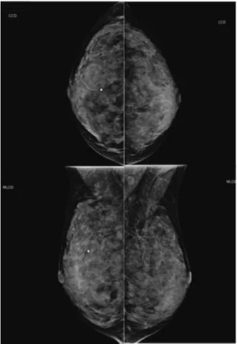 Fig. 2 Right mammography in absolute pro ﬁ le view showing an area of slight architectural distortion next to the metal marker at the junction of the upper quadrants of the right breast (palpation area reported by the patient).