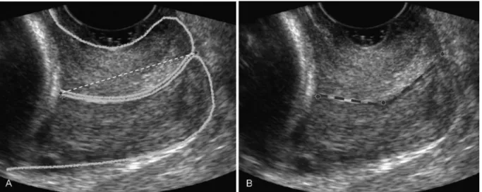 Fig. 1 Biometry of the uterine cervix using the continuous (A) and the segmented (B) techniques.