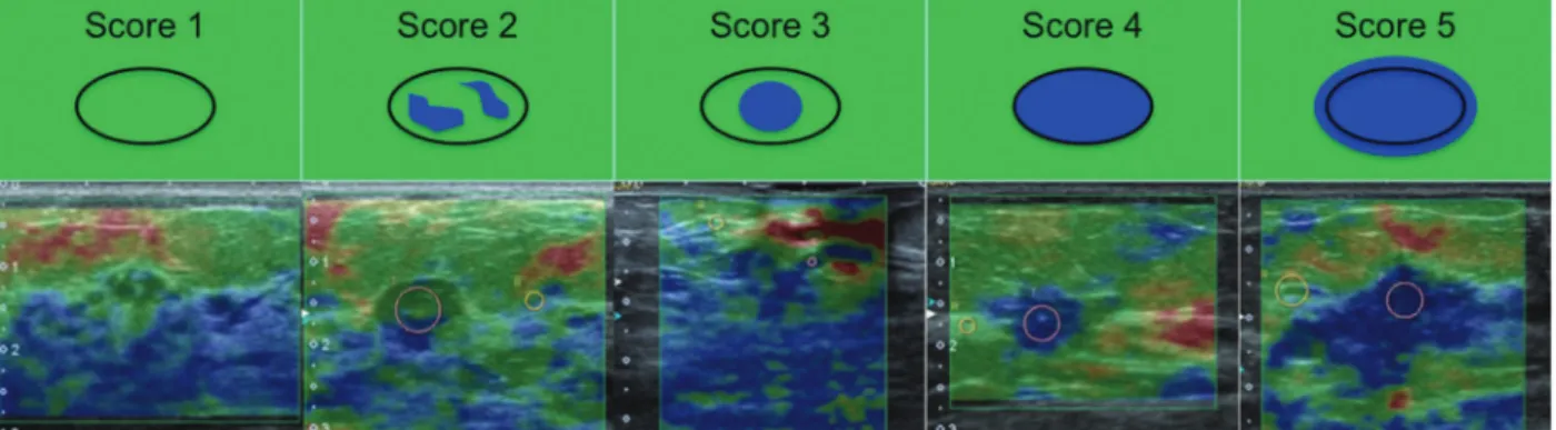 Fig. 2 Example of elastography analysis, showing a conventional ultrasound image on the right and an elastography image on the left, used for the qualitative analysis