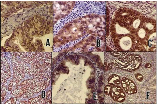 Table 3 Sensitivity, speciﬁcity, and negative and positive predictive values for p16 ink4a in the diagnosis of adenocarcinomas of the cervix