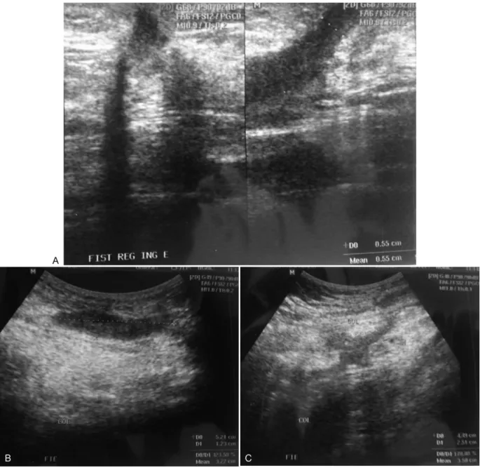 Fig. 1 Abdominal ultrasound showing a hypoechoic tract located in the left inguinal region (panel A); a hypoechoic area located in the subcutaneous tissue, suggesting ﬂ uid collection, and showing communication with the external environment through the afo
