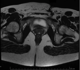 Fig. 4 Physical examination showing secretion drainage of the cutaneous opening in the left iliac fossa.