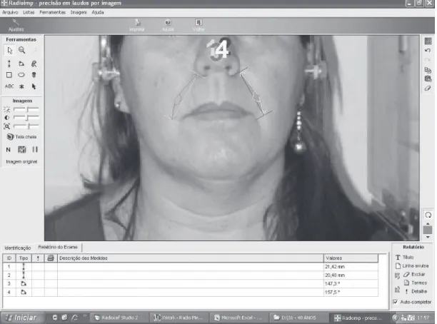 Figure 1. Photo evaulation using Radiocef Studio 2.0 ®  software, Natal, RN, 2011.
