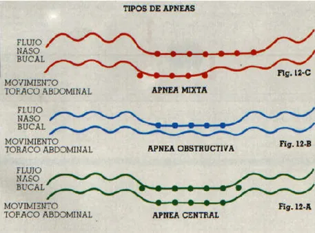 Figura 2: Fluxo oro-nasal e movimentos toraco-abdominais nos diferentes tipos de 