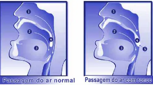 Figura 6: Passagem de ar normal e na presença de roncopatia. 1- Via aérea nasal, 2- 