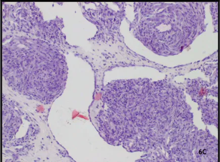 Figura 6 (A,B e C com ampliação sequencial): Proliferação vascular  de canais dilatados e anastomosados entre si; alguns eritrócitos no  lúmen