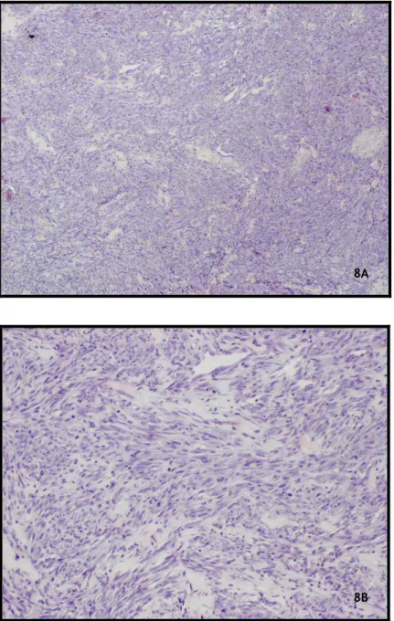 Figura  8  (A  e  B  com  ampliação  sequencial):  Área  de  tumor  com  interstício de colagénio, sólido em algumas áreas