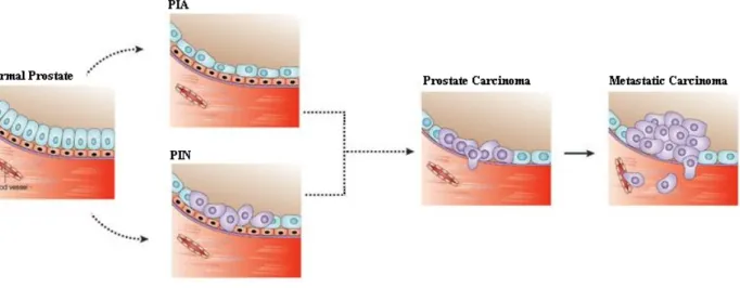 Figure  4-  Squematic  demonstration  of  the  three  progression  stages  from  normal  to  metastatic prostate tissue (Adapted from (Nelson &amp; Montgomery 2003))