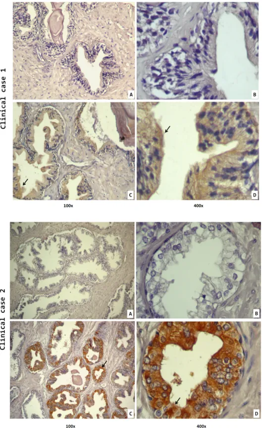 Figure 9- STEAP1 immunoreactivity in 2 of 60 cases of human prostate cancer samples. A, B-  Negative  control  (without  primary  antibody)  ; C,  D- Tissue  sections  were  incubated  with   anti-STEAP1 polyclonal antibody (1:100)