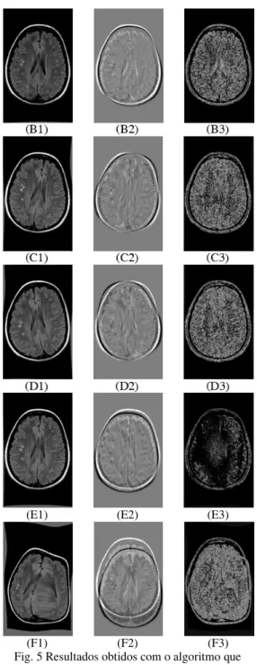 Fig. 4 Resultados obtidos com o algoritmo que  considera uma transformação rígida. 
