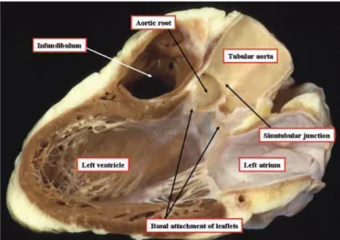 Fig. 2 – A raiz aórtica, estendendo-se desde a ligação basal dos folhetos até à junção sinotubular, ocupa o centro  do coração