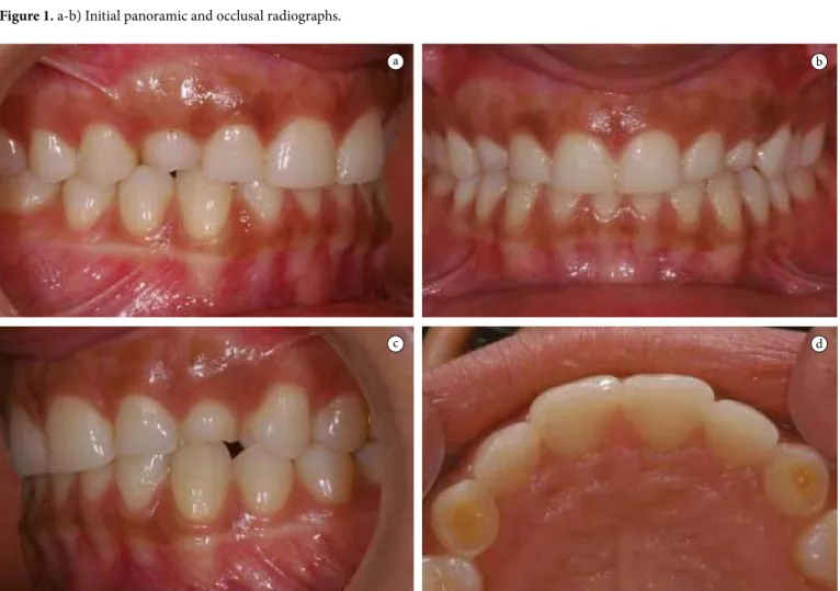 Figure 2. a-d) Initial intra-oral photographs.