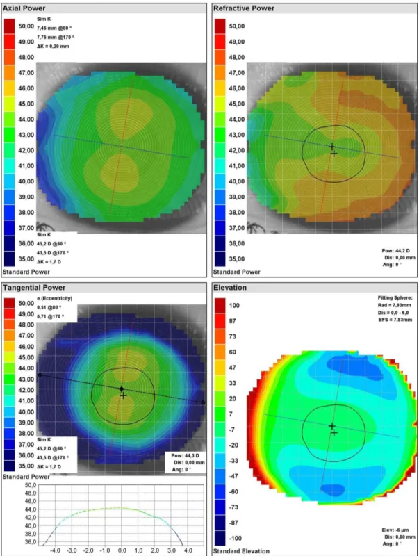 Figura 4 – Mapa topográfico do OD do caso de adaptação de lentes de contacto hidrófilas tóricas