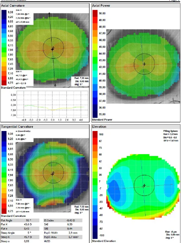 Figura 1. Registos topográficos da superfície anterior do olho direito adquiridas pelo topógrafo corneal  Medmont Studio – Version 4.9.0.0.