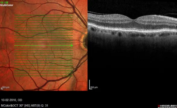 Figura 2: Oftalmoscopia Confocal de Varrimento macular do olho direito e respetiva imagem de  OCT