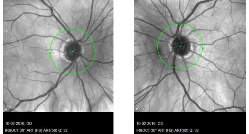 Figura 6: OCT com centragem no disco ótico no olho direito e no olho esquerdo. 