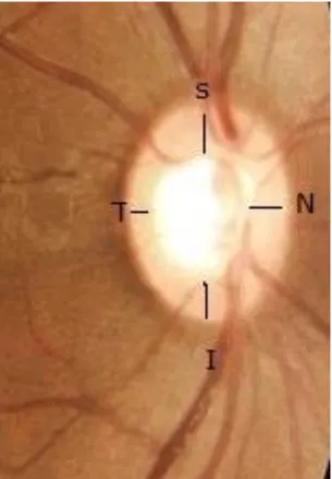 Figura 3 - Ampliação da área do Nervo Óptico do OD : A regra ISNT não se verifica. 