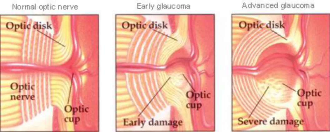 Figura 2.2 – Alteração da papila ótica com a evolução do Glaucoma (5). 