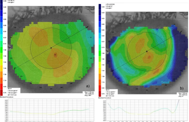 Figura 7.7.3 - a) Mapa de curvatura axial; e  b)  Mapa de curvatura Tangencial do OD para o caso de  adaptação de LCHT (imagem cedida pela Clínica Dr