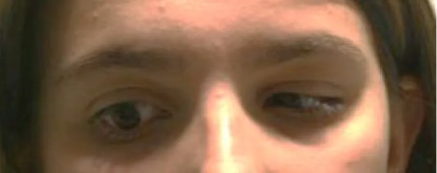 Figura 9- Posição secundária do olhar, Levoversão (abdução olho afectado)
