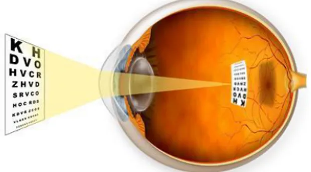 Figura 11. Ilustração do olho representando a formação da imagem num olho míope (38) Entre as várias causas para a miopia existem três que se destacam: (35,36) 