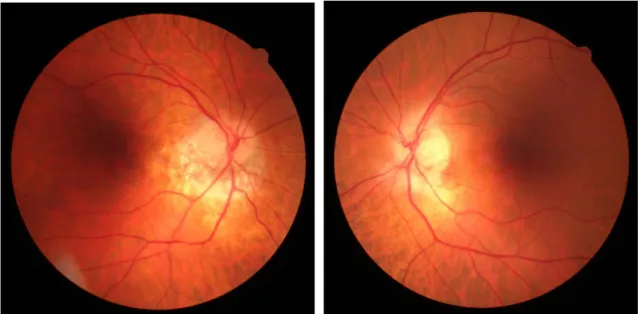 Figura  3:  Retinografia  do  olho  direito  e  retinografia  do  olho  esquerdo  (imagens  cedidas  pelo  CCECV)
