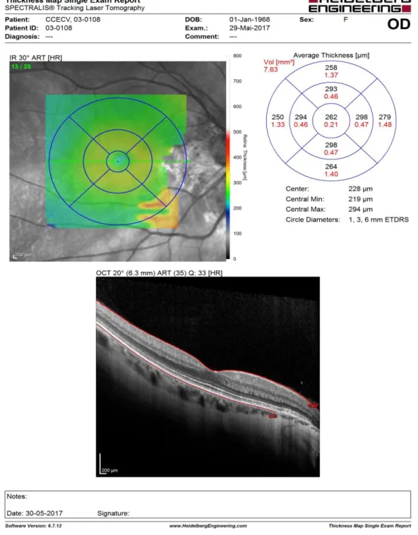 Figura 4 a): Tomografia de coerência ótica com centragem macular do olho direito (imagem cedida pelo  CCECV)