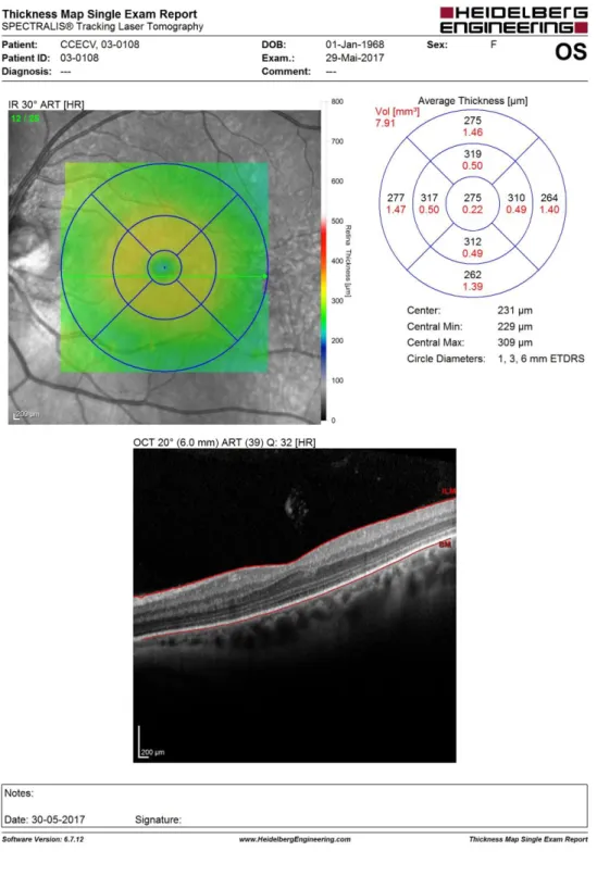 Figura 4 b): Tomografia de coerência ótica com centragem macular do olho esquerdo (imagem cedida  pelo CCECV).