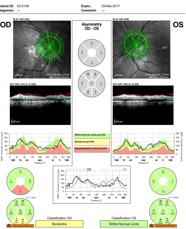 Figura 5: Tomografia de coerência ótica com centragem papilar do olho direito e do olho esquerdo  (imagem cedida pelo CCECV).