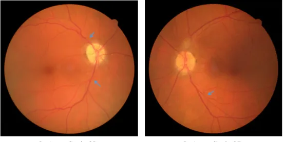 Figura 1.1: Retinografias do caso Suspeita de neuropatia óptica isquémica. As setas azuis re- re-presentam sinais de Marcus Gunn.