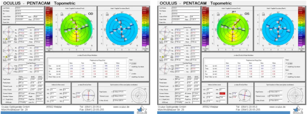 Figura 3.1: Resultados obtidos pela Pentacam para o OD e OE respectivamente.