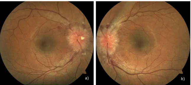 Figura 1 – Retinografia não midriática: a) Olho Direito; b) Olho Esquerdo (imagem cedida pela Clínica  Dr