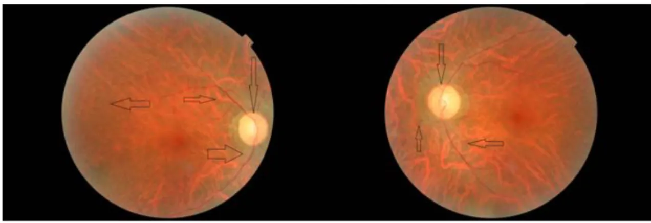 Figura 4: Retinografia do olho direito (à esquerda) e do olho esquerdo (à direita).  