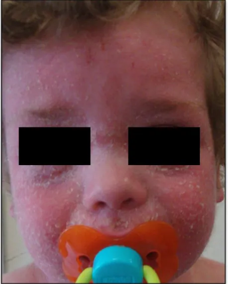 Figura 1 – Pormenor da face de uma criança de 3 anos com Dermatite Atópica. 