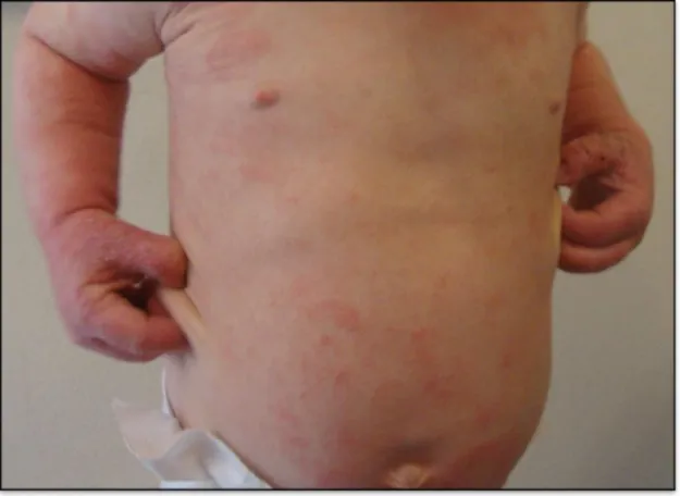 Figura 2 - Pormenor do abdómen de uma criança de 3 anos com Dermatite Atópica. 