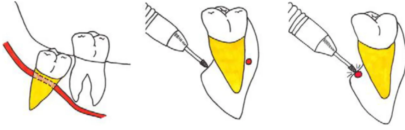 Figura 1 - Localização do NAI por vestibular ou lingual durante a osteotomia. (Ghaeminia et al., 2011 - sem  autorização do autor) 