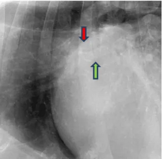 Figura 9. Distensão selectiva da veia pulmonar lobar cranial direita devido a hipertensão venosa  pulmonar secundária a DDCVM (adaptado de Thrall, 2006)