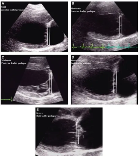 Figura 12. Imagens ecocardiográficas de prolapso da válvula mitral em vista paraesternal direita  com uma imagem em eixo longo de 4 câmaras (adaptado de Terzo et al., 2009)