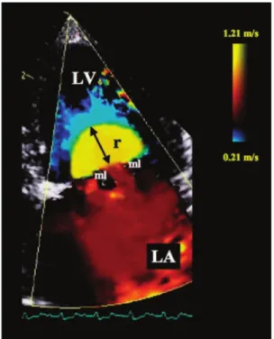 Figura 14. Imagem de Doppler de cor (com traçado ECG contínuo) da vista apical esquerda de  4 câmaras ilustrando o hemisfério da região de convergência de fluxo proximal à VM num cão  com DDCVM (adaptado de Gouni et al., 2007)