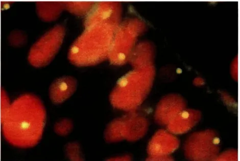 Figura 1- Carcinoma urotelial da bexiga. Monossomia do cromossoma 9 (lOOOx). 