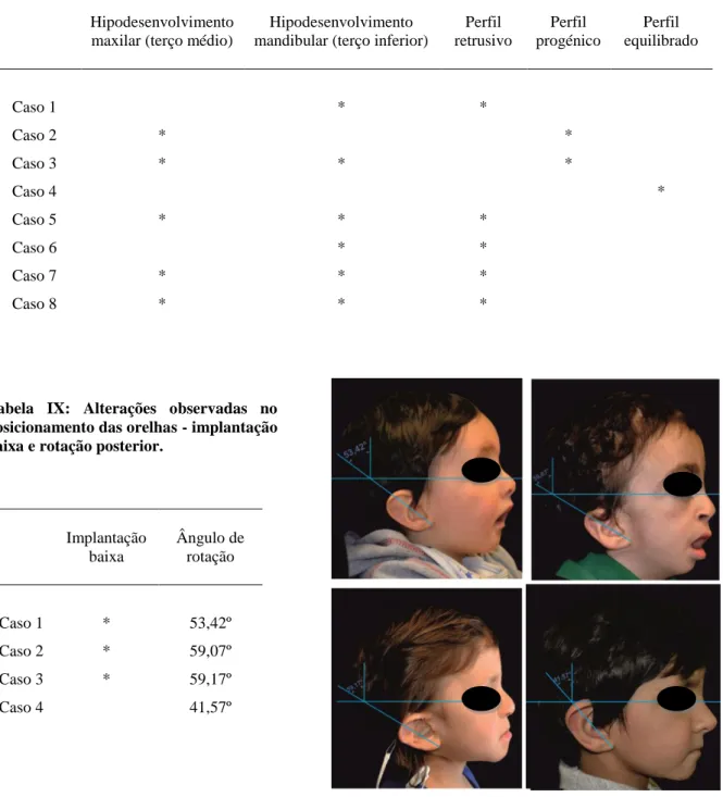 Tabela VI: Análise da simetria facial. 