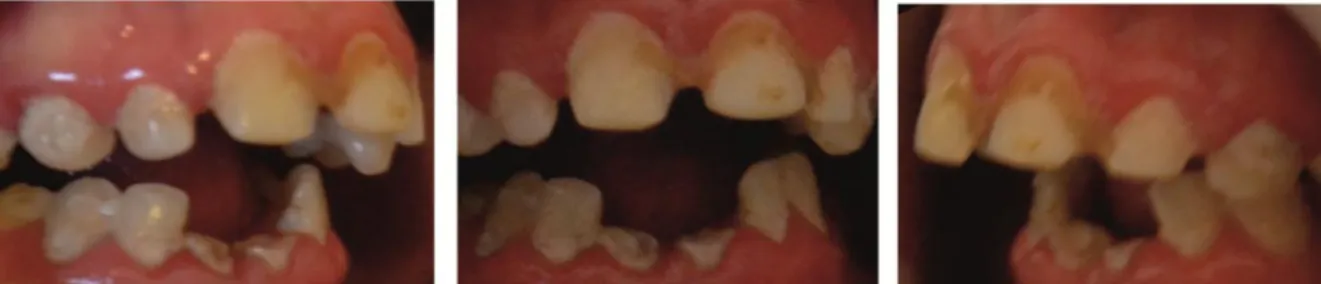 Fig.  25:  Radiografia  panorâmica  correspondente  ao  caso  6.  Pode  observar-se  a  agenesia  dos  terceiros  molares  (28,  38  e  48)  e  restaurações  oclusais  em  dois  molares (26 e 36)