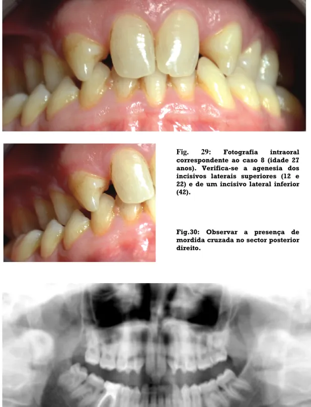 Fig. 31:  Radiografia panorâmica correspondente ao caso 8 . Pode confirmar-se a agenesia  dos  incisivos  laterais  superiores  (12  e  22),  de  um  incisivo  lateral  inferior  (42)  e  dos  terceiros molares (18, 28, 38)