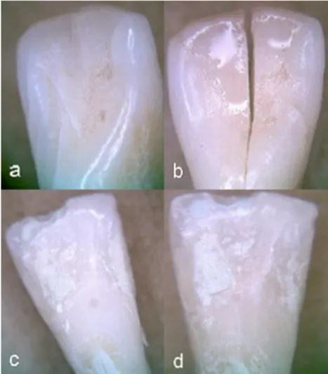 Figura 8: Efeitos do hidróxido de sódio na dentição. Fig a e b mostram o mesmo  incisivo  após  24h  de  exposição  a  28%  do  produto