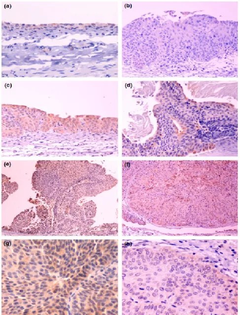 Fig.  3-  CK20  immunostaining  in  BBN-induced  rat  bladder  lesions.  a-  control  animal