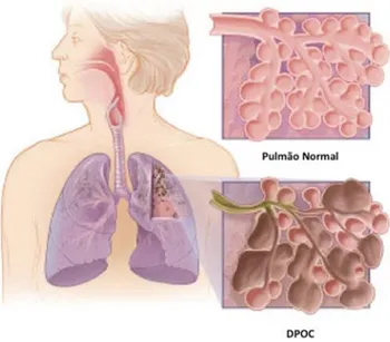 Figura 4 - Diferenças no pulmão entre uma pessoa normal e um doente com DPOC [12]
