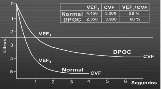 Figura 6 - Espirograma Normal e Espirograma característico de doentes com DPOC Ligeira ou Moderada  [15] 