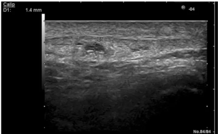 Figura  9  –  RM  com  alterações  de  intensidade  do  sinal  do  tendão  rotuliano  e  um  Figura  8  -  Ecografia  do  tendão  rotuliano  com  uma  região hipoecóide (D1)