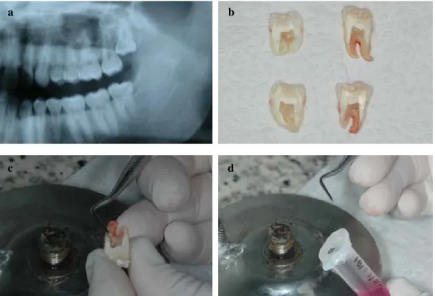 Figura 3: Coleta do tecido pulpar de dente permanente: (a) Radiografia panorâmica da região  dos 28 e 38 na seleção dos dentes (permanentes) com indicação cirúrgica de extração: (b)  Dentes após serem seccionados; (c) Remoção do tecido pulpar; (d) Colocaçã