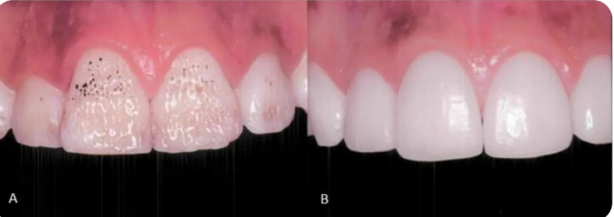 Figura 2 (adaptado sem a autorização do autor): A-dentes anteriores superiores afetados por  amelogénese imperfeita hipoplásica; B-reabilitação com facetas cerâmicas
